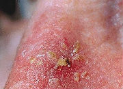 actinic_keratoses_ak