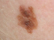atypical_mole