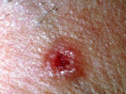 basal_cell_carcinoma_bcc
