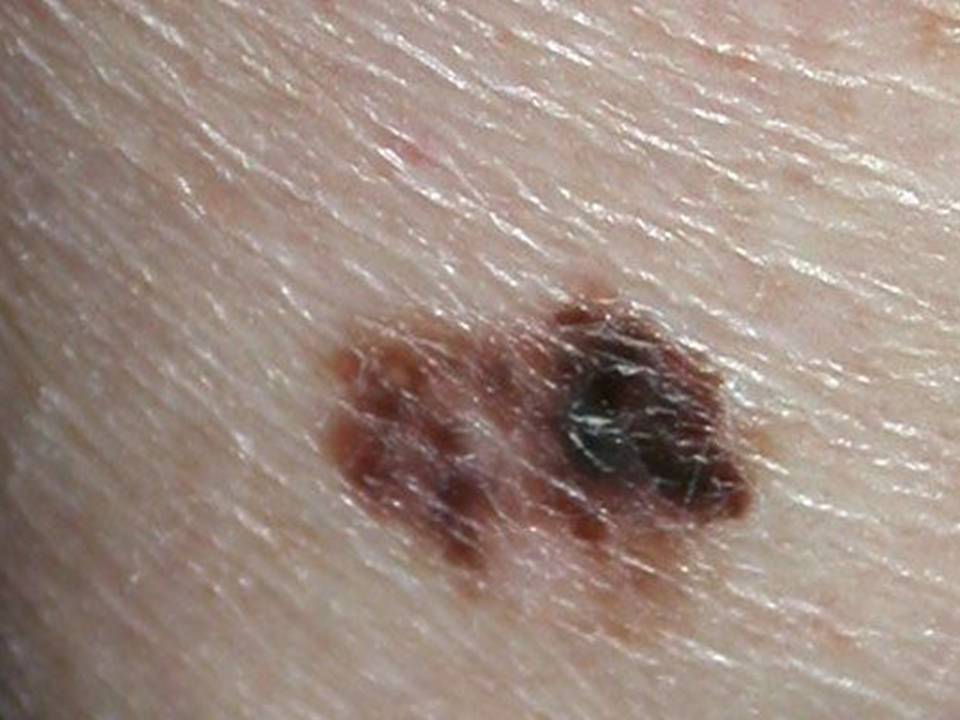 malignant-melanoma-mm-naaman-skin-and-laser-centre