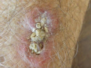 squamous_cell_carcinoma_scc